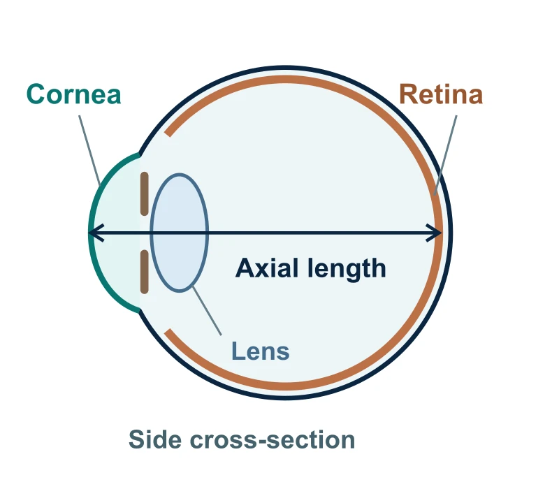 Side cross-section of the eye: the axial-length arrow begins at the front corneal surface and ends at the posterior retina. The internal lens is behind the iris.
